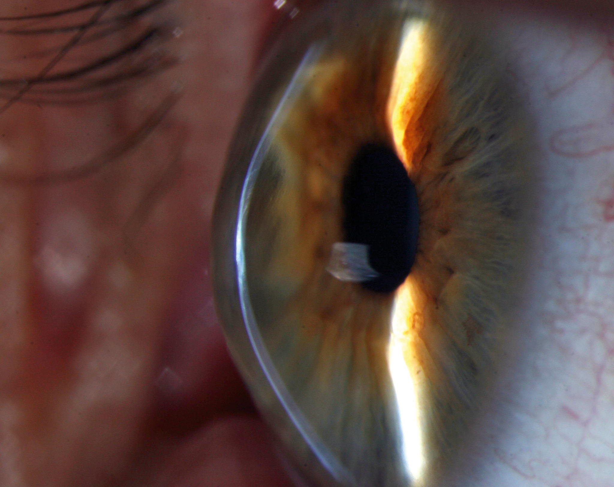 O ceratocone faz com que os olhos assumam um formato cônico.